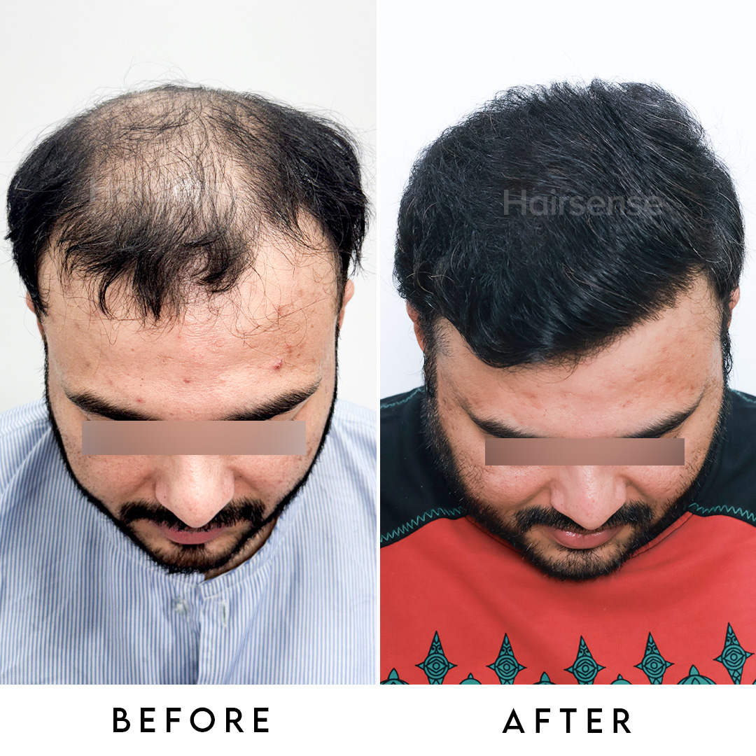 Hair transplant result 3